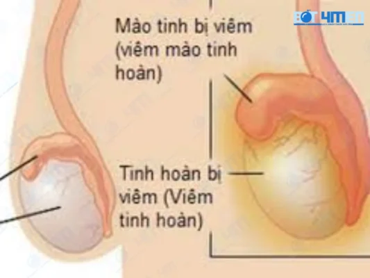 Triệu chứng vô sinh ở nam 