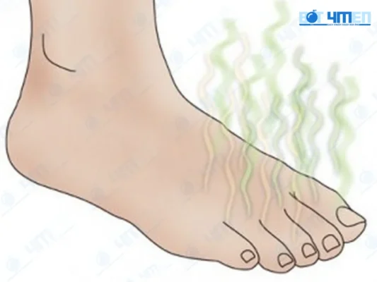 Bị hôi chân nặng