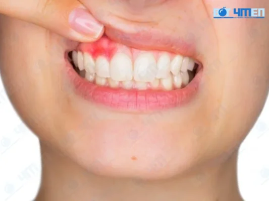 Các bệnh về răng miệng gây ra hôi miệng