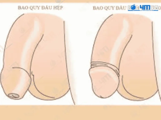 Đâu mới đúng là bao quy đầu bình thường 