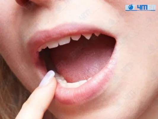 Khoan miệng bị khô gây ra hôi miệng