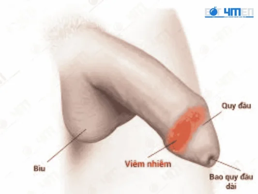 Nếu chúng ta không cắt bao quy đầu thì sẽ bị viêm nhiễm 