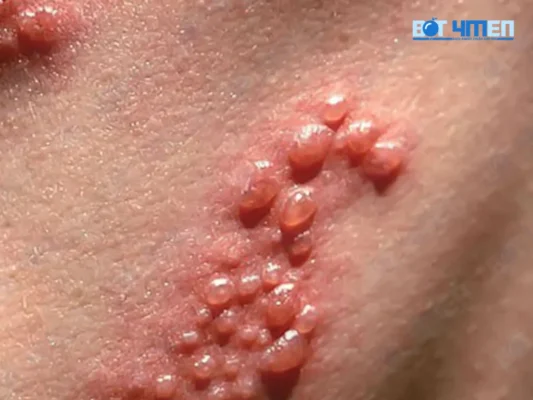 Cách điều trị mụn rộp giai đoạn đầu