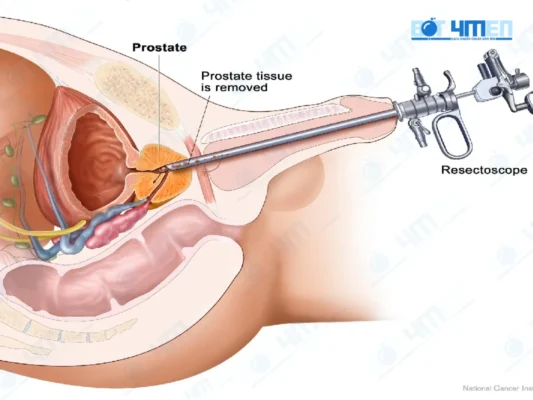 Cách điều trị ung thư tuyến tiền liệt