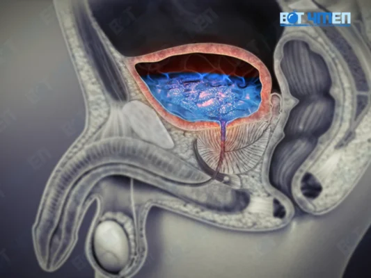 Cách điều trị viêm đường tiểu nam