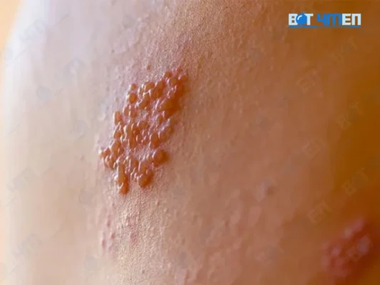 Cách phòng ngừa mụn rộp