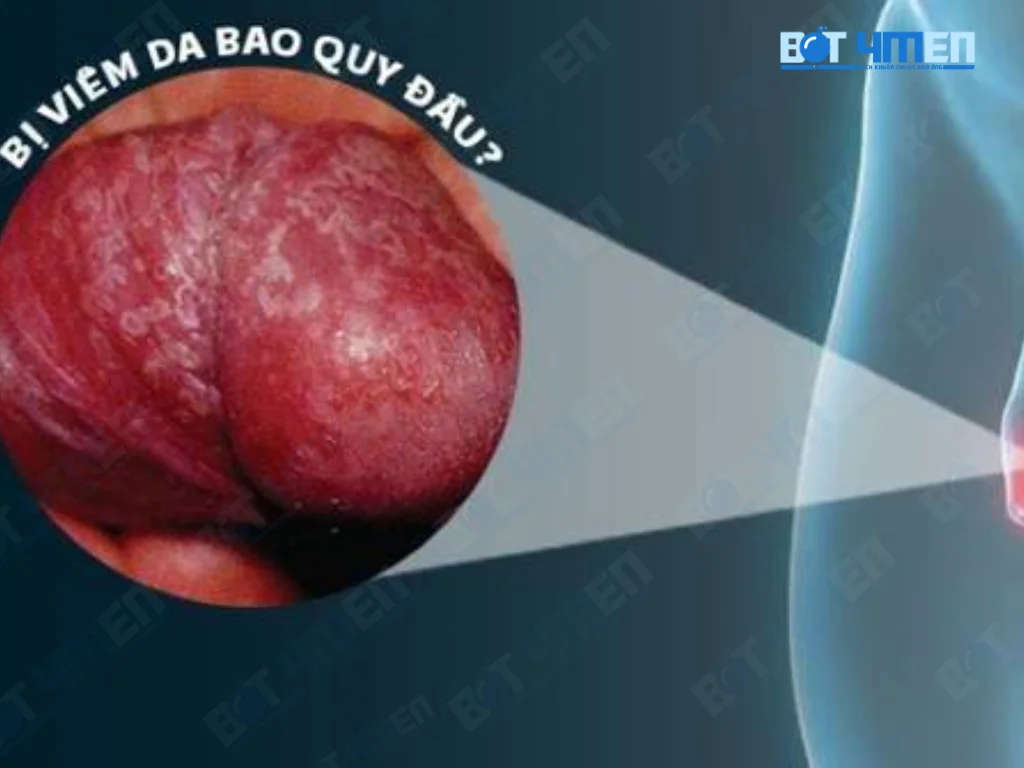 Cách trị bao quy đầu tại nhà