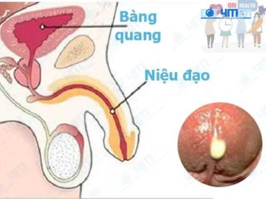 Chuẩn đoán viêm đường tiểu nam
