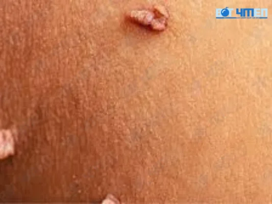 Dấu hiệu nhận biết bị HPV