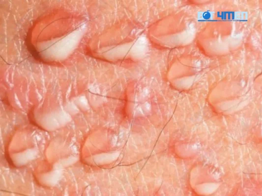 Dấu hiệu nhận biết bị mụn rộp