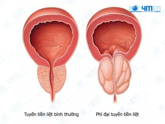 Dấu hiệu nhận biết ung thư tuyến tiền liệt