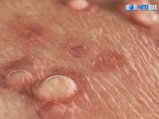 HPV có điều trị được không