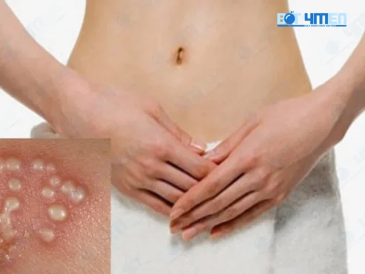 Mụn rộp có tự khỏi được không