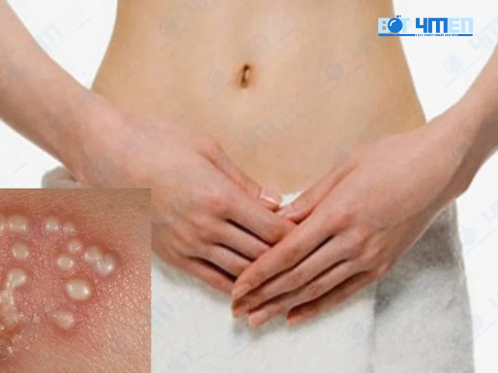 Mụn rộp có tự khỏi được không