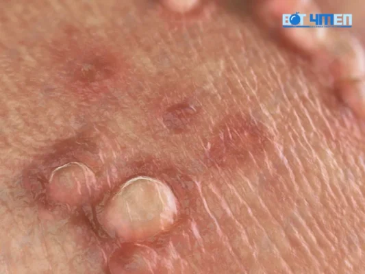 Nguyên nhân bị mụn rộp giai đoạn đầu