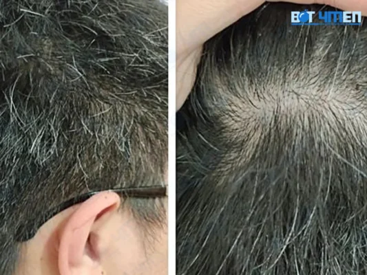 Nguyên nhân gây tóc bạc sớm