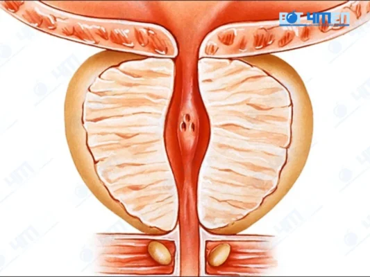 Phân loại giai đoạn viêm tuyến tiền liệt