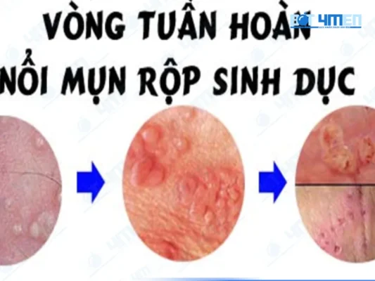 Triệu chứng mụn rộp giai đoạn đầu