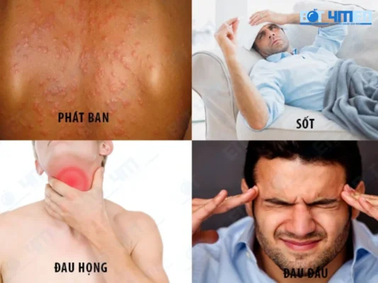 Triệu chứng thường gặp khi bị HIV