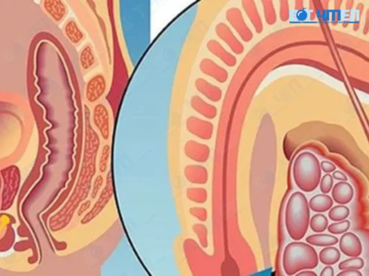 Ung thư tinh hoàn có chữa được không