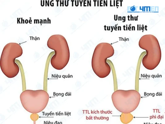 Ung thư tuyến tiền liệt chữa khỏi không