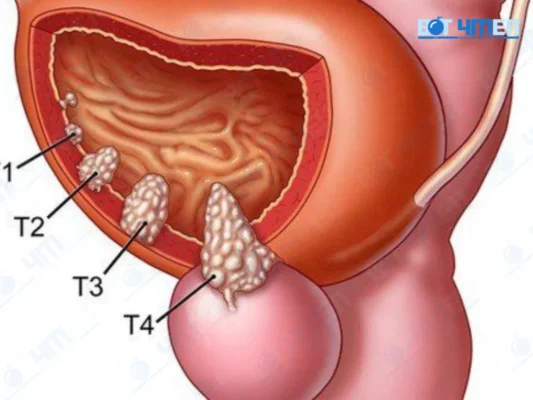Vì sao cần nhận biết ung thư tuyến tiền liệt