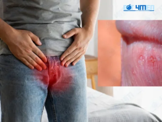 Viêm bao quy đầu có tự khỏi không