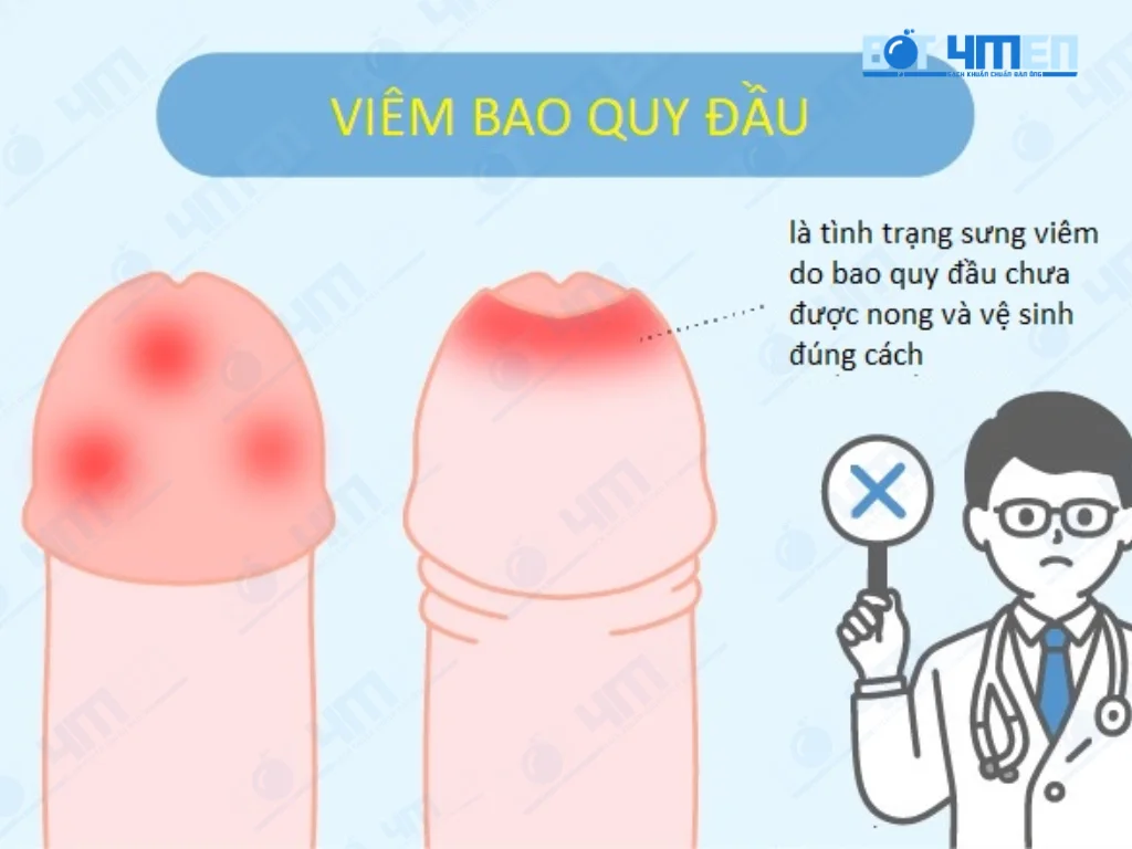 Viêm bao quy đầu có tự khỏi không