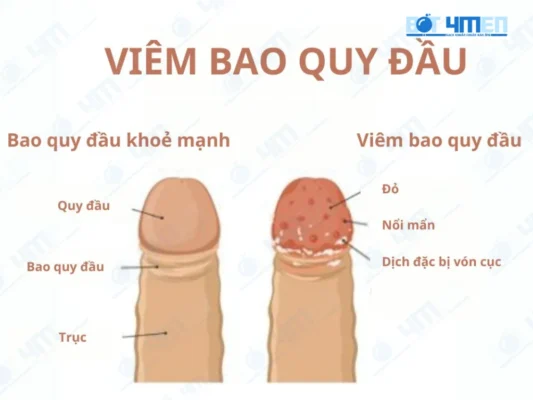 Viêm bao quy đầu là gì
