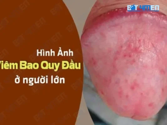 Viêm bao quy đầu là gì