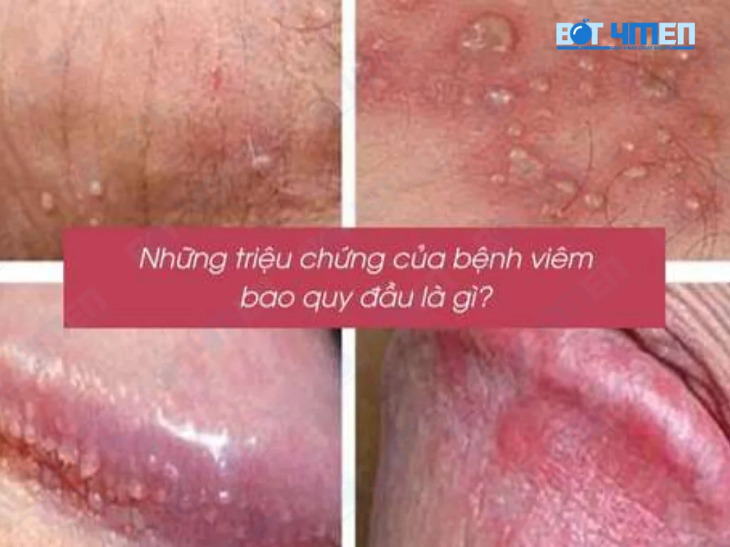 Viêm bao quy đầu nguyên nhân