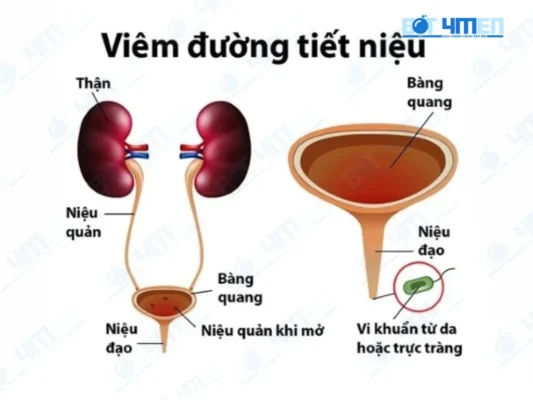 Viêm đường tiết niệu là gì