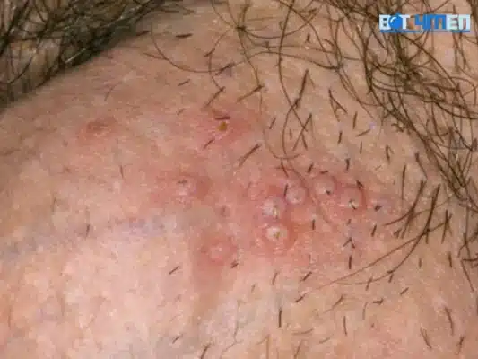 Mụn rộp sinh dục là gì