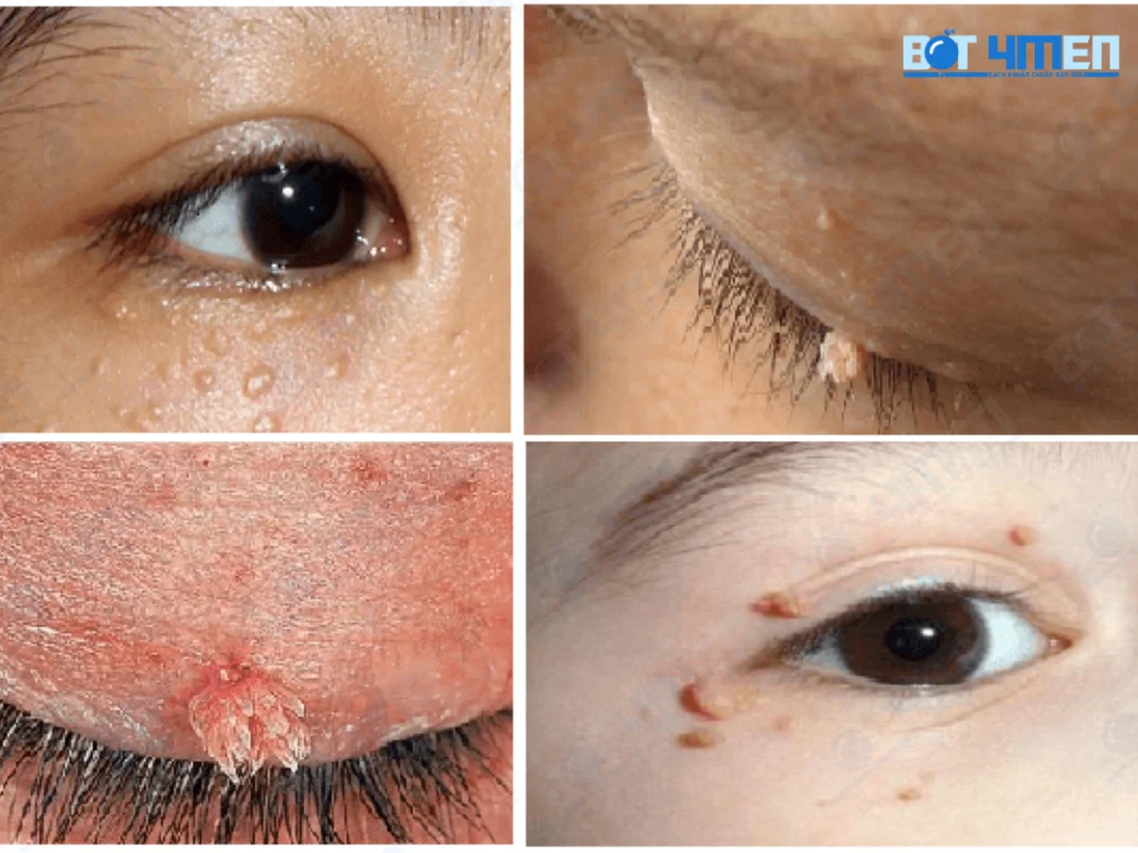 Nguyên nhân bệnh sùi mào gà