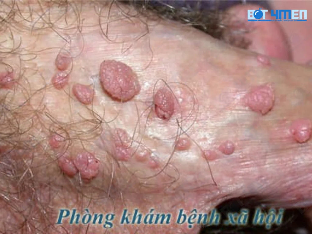 Phòng ngừa bệnh sùi mào gà