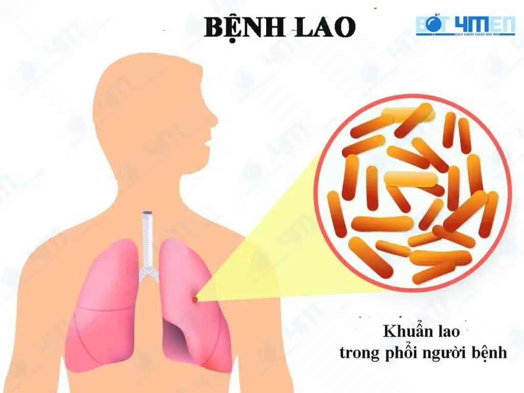 Triệu chứng bệnh lao phổi