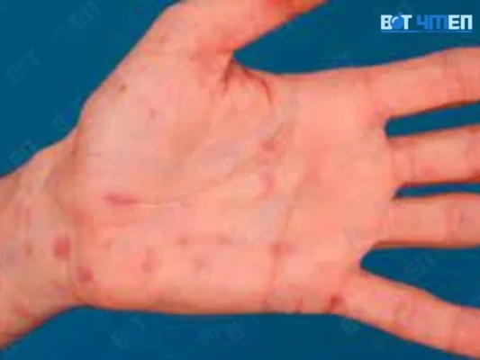 Triệu chứng bệnh lậu