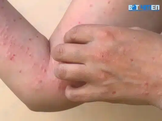 Triệu chứng của bệnh AIDS