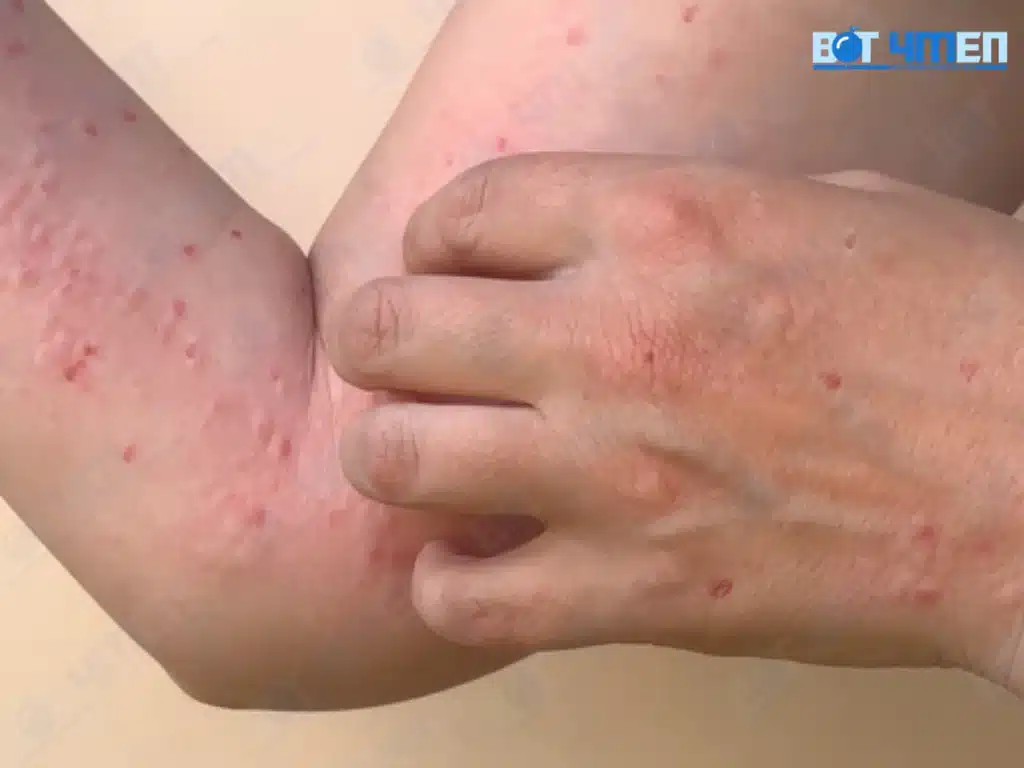 Triệu chứng của bệnh AIDS