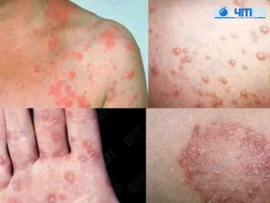 Triệu chứng của bệnh lậu