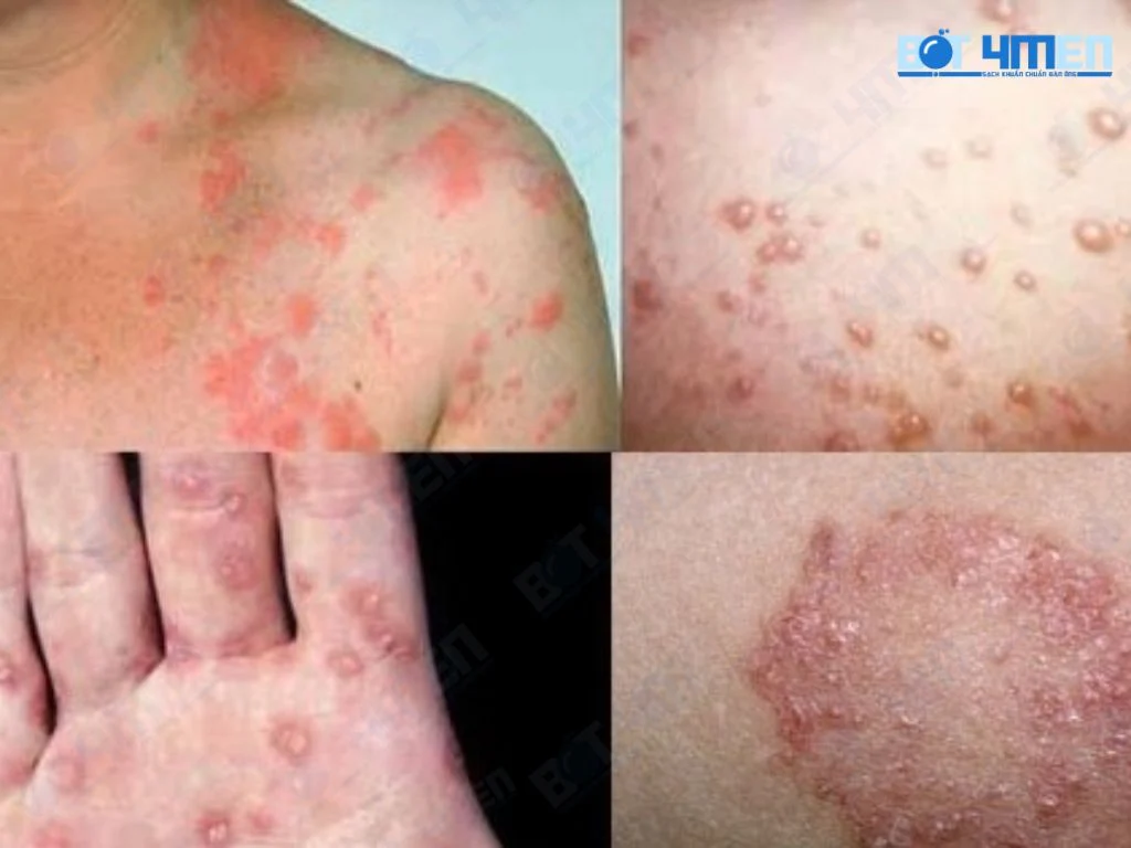 Triệu chứng của bệnh lậu