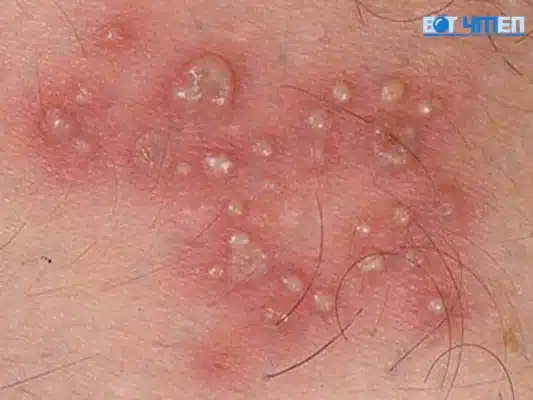 Triệu chứng mụn rộp sinh dục