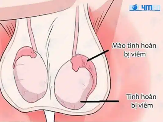Viêm tinh hoàn là gì