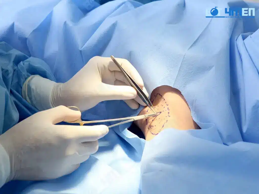 Cắt tuyến mồ hôi nách