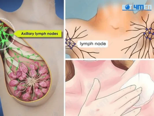 Cơ chế của phẫu thuật cắt tuyến mồ hôi nách