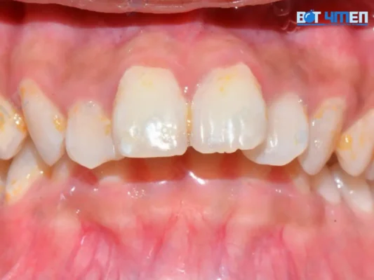 Vệ sinh răng miệng kém nguyên nhân hàng đầu